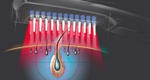 Tratamento capilar a laser