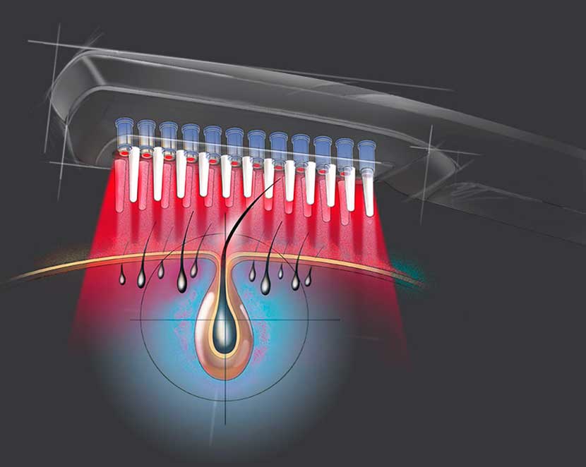 Tratamento capilar a laser: Como funciona?